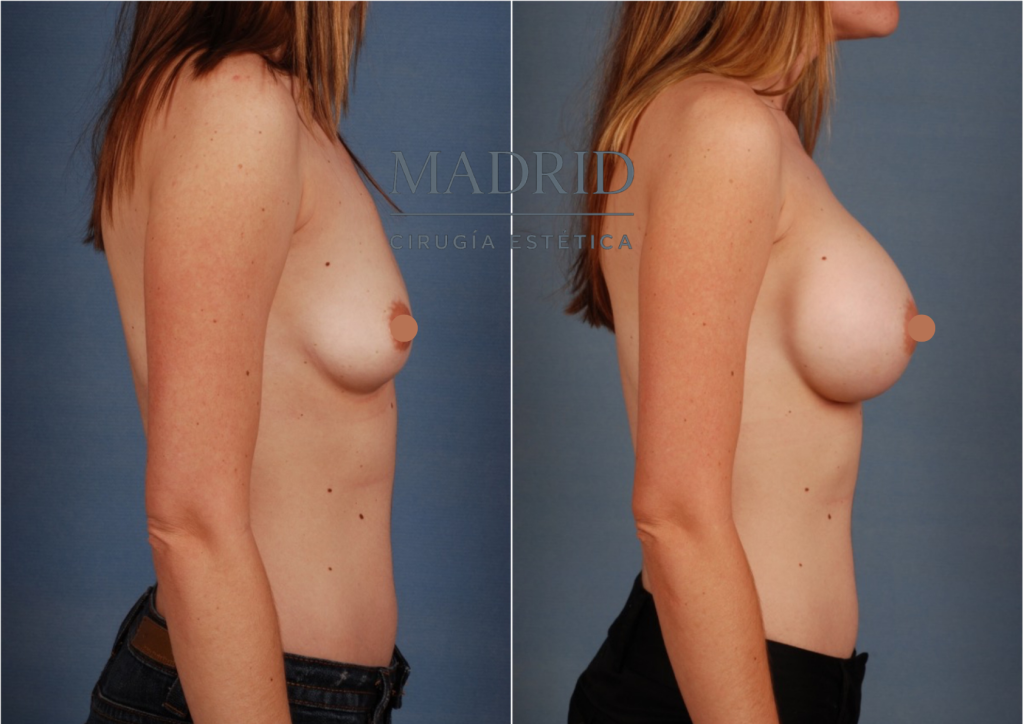 aumento de pecho madrid