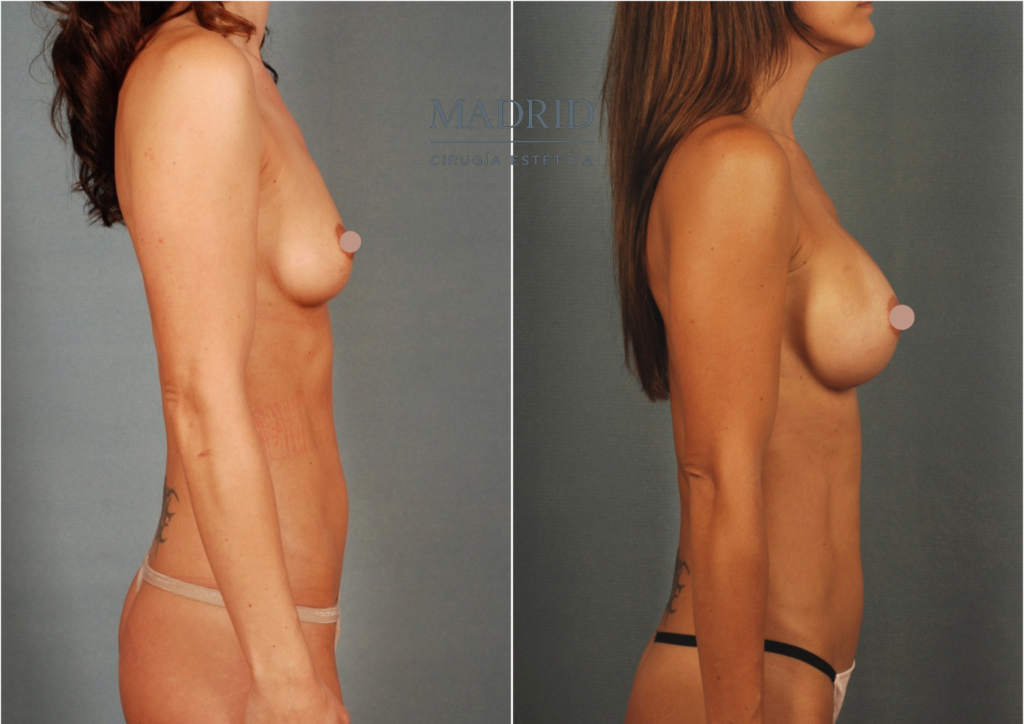 mastopexia madrid