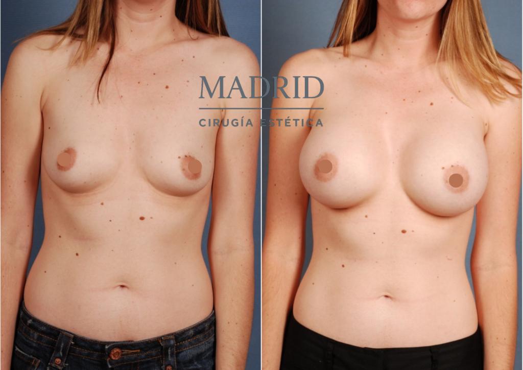 aumento de pecho madrid