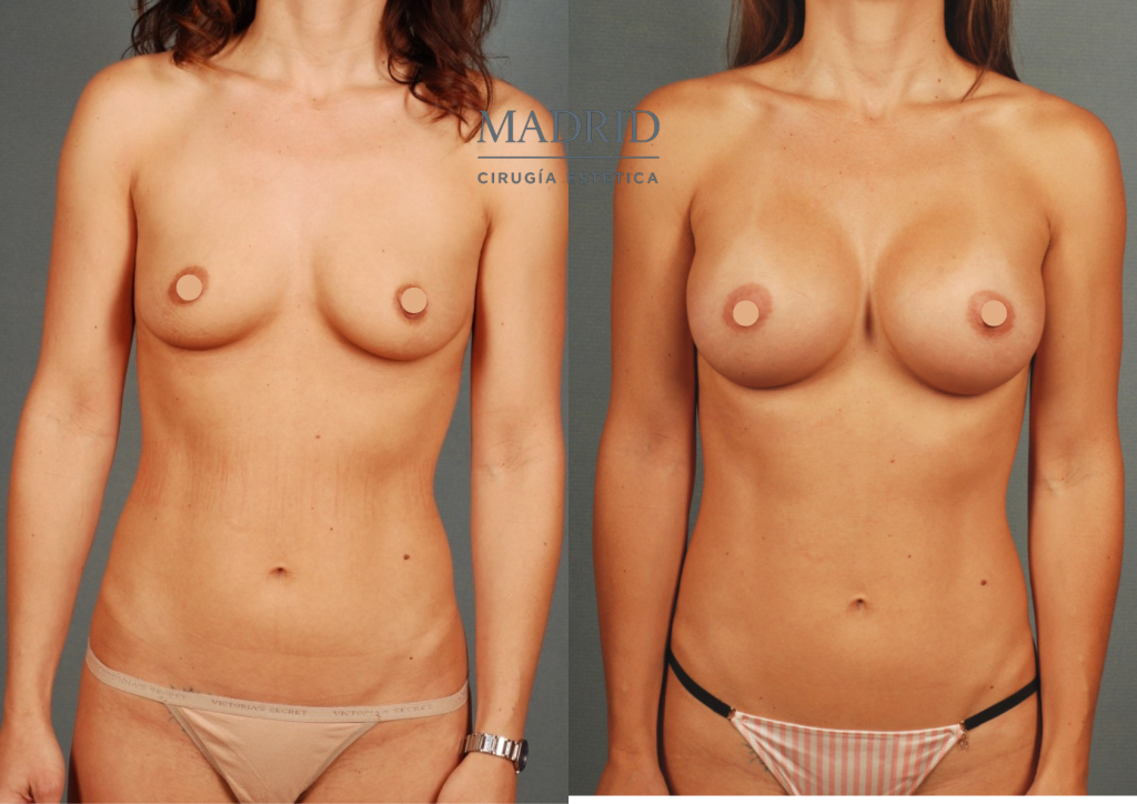 mastopexia madrid