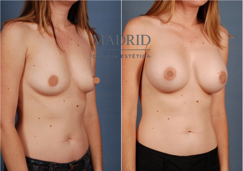 aumento de pecho madrid