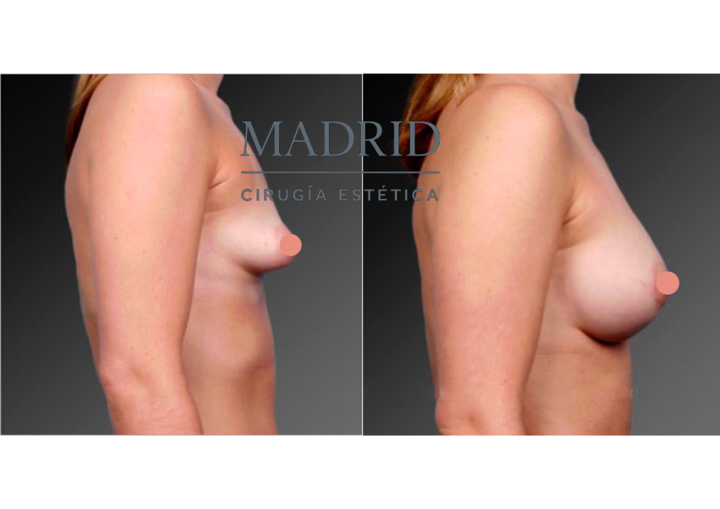 mama tuberosa antes y después fotos