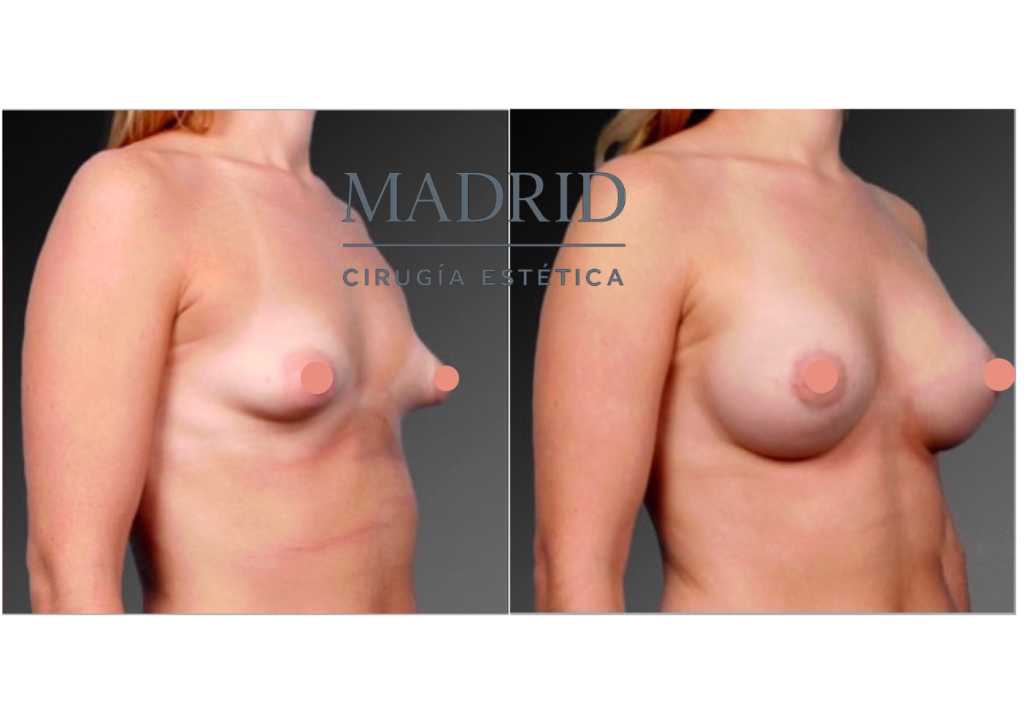 mama tuberosa antes y después fotos