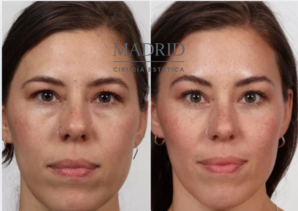 blefaroplastia antes y despues fotos