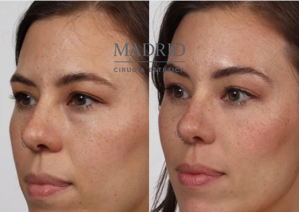 blefaroplastia antes y despues fotos