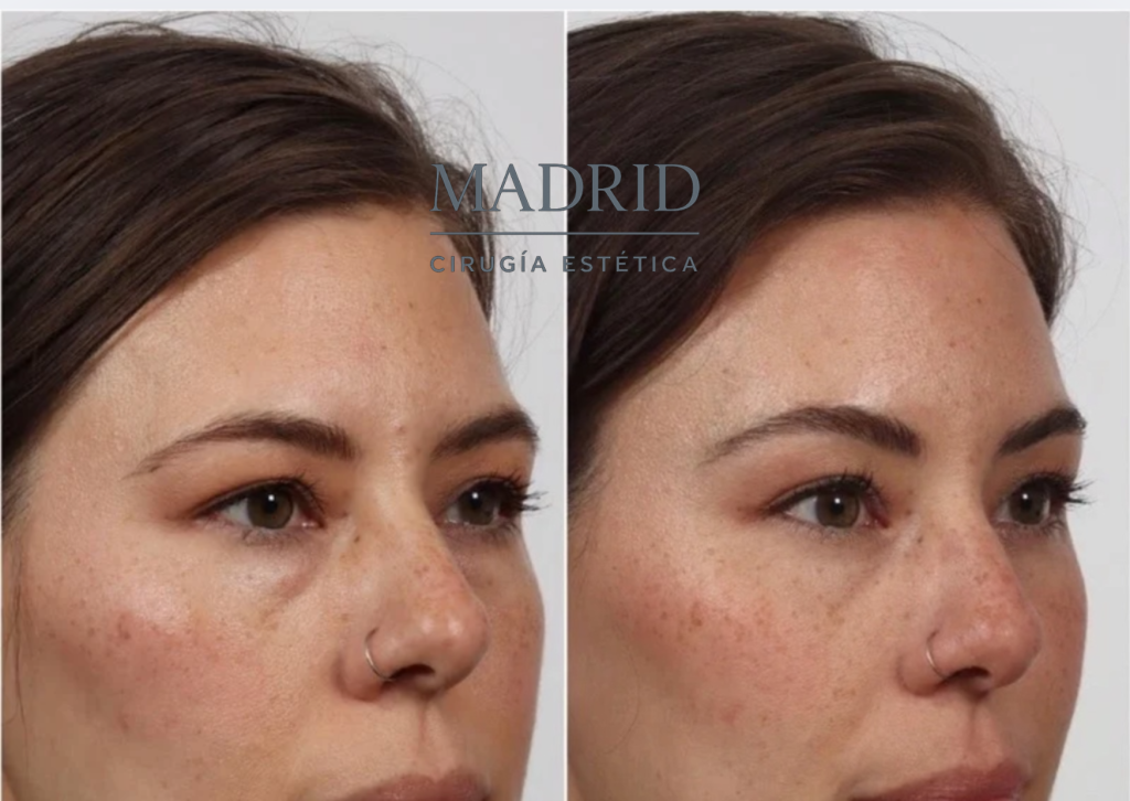 blefaroplastia antes y despues fotos
