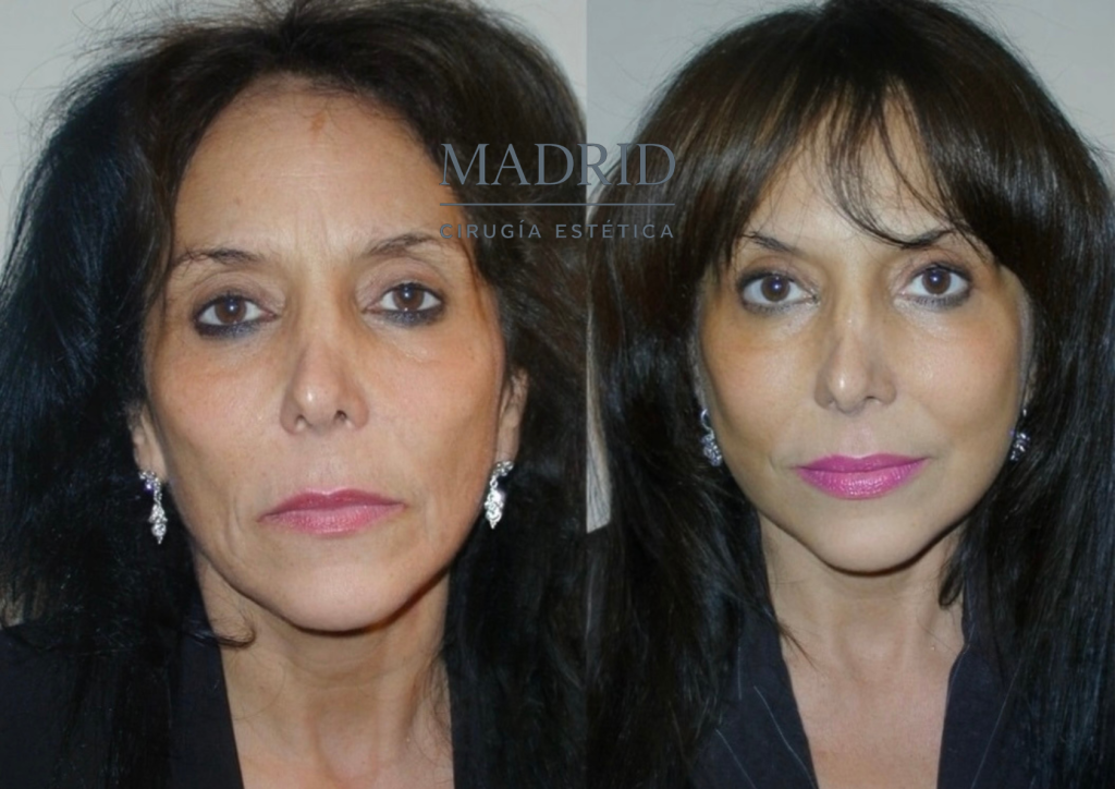 face lift antes y después fotos