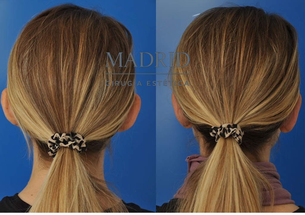 Otoplastia en adultos Madrid antes y después fotos