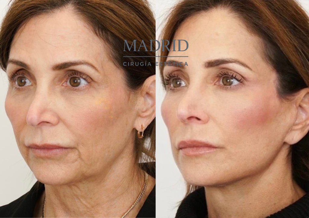 lifting facial antes y después fotos