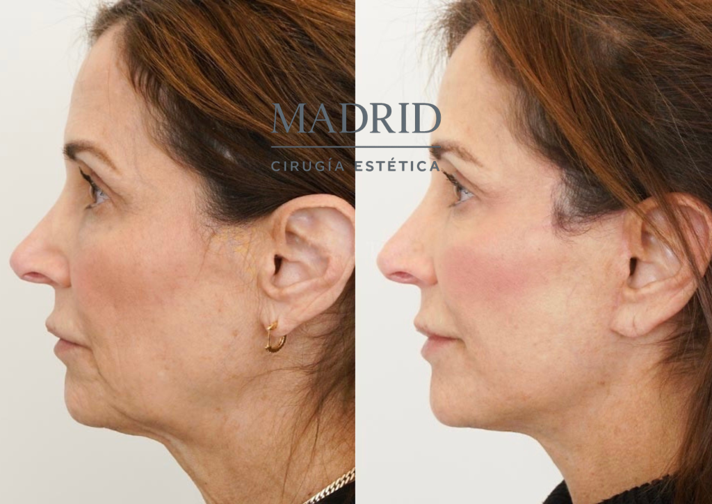 lift facial antes y después fotos