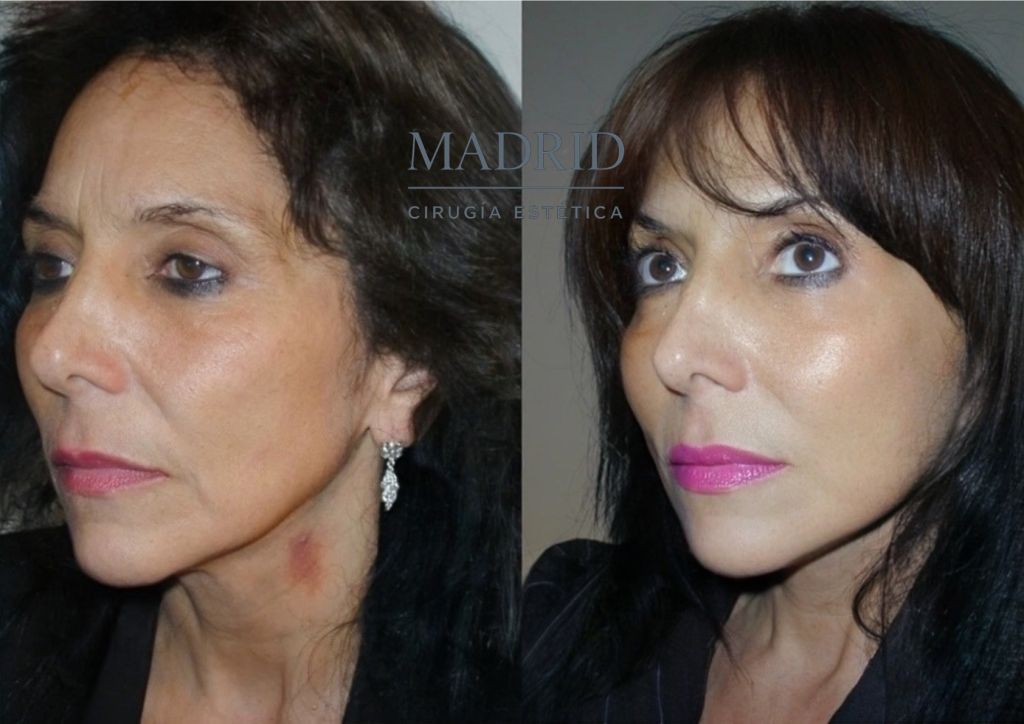 lifting facial antes y después fotos