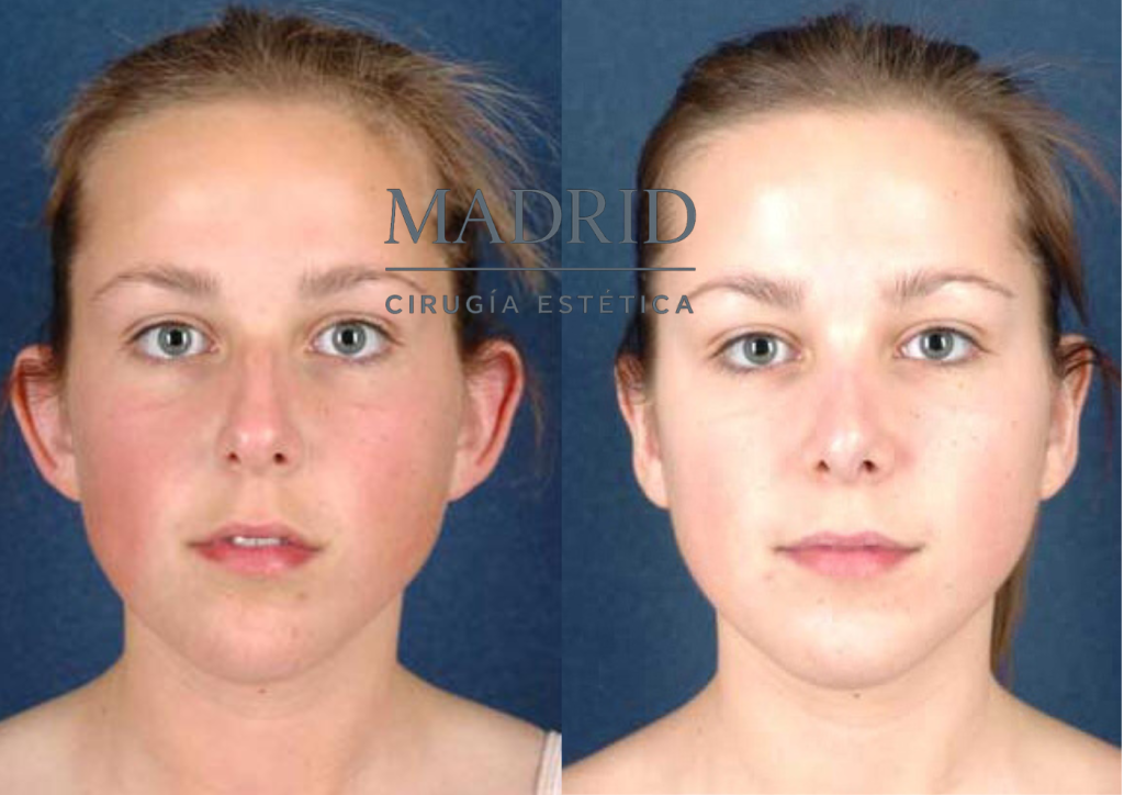Otoplastia en adolescente Madrid antes y después foto