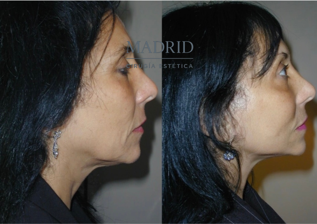 antes y después lifting facial fotos