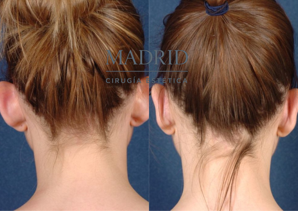 Otoplastia en adolescente Madrid antes y después foto