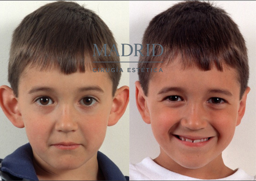Otoplastia infantil Madrid