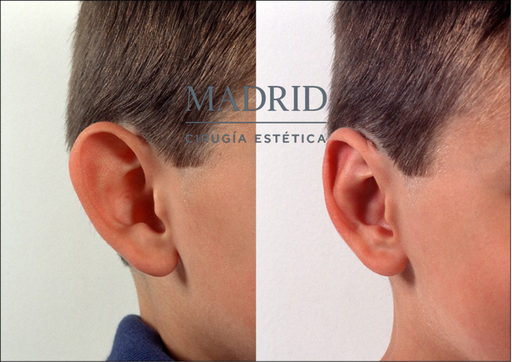 Operación de orejas niños Madrid