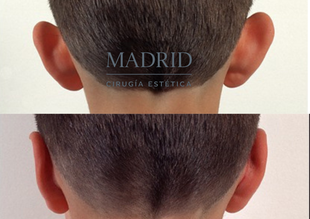 Otoplastia niños Madrid