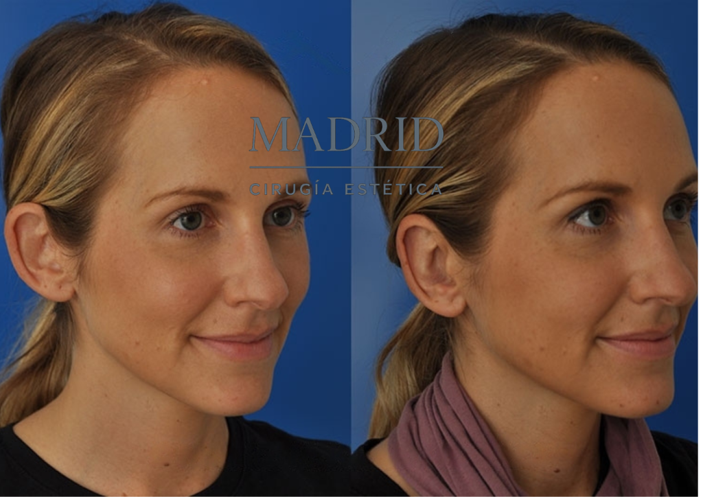 Otoplastia en adultos Madrid antes y después fotos