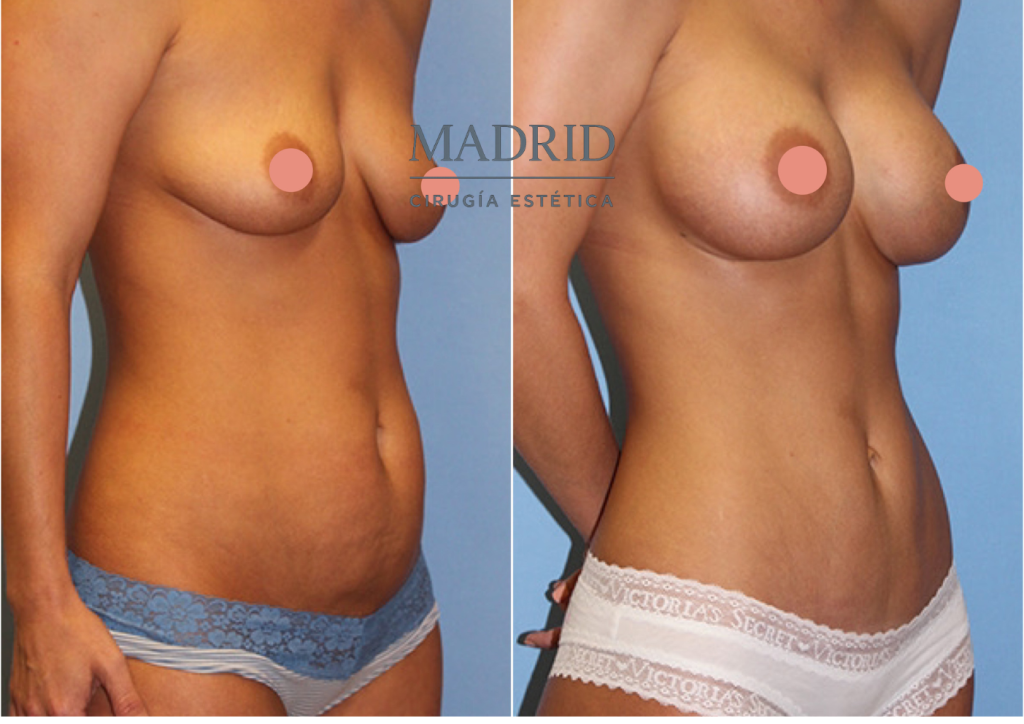 antes y después de una abdominoplastia en Madrid fotos