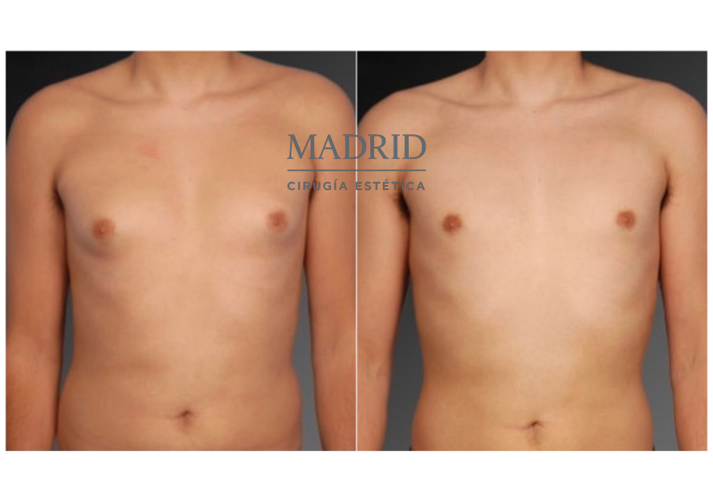 Ginecomastia en Madrid
