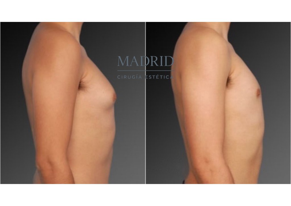 Ginecomastia antes y después