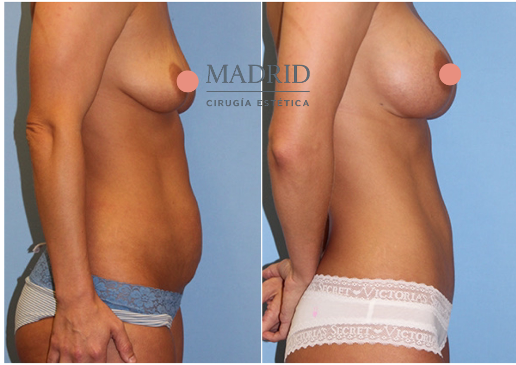abdominoplastia antes y después fotos