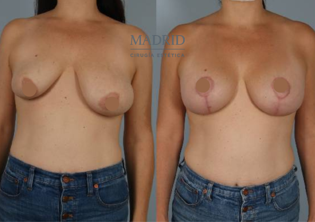 Mastopexia madrid