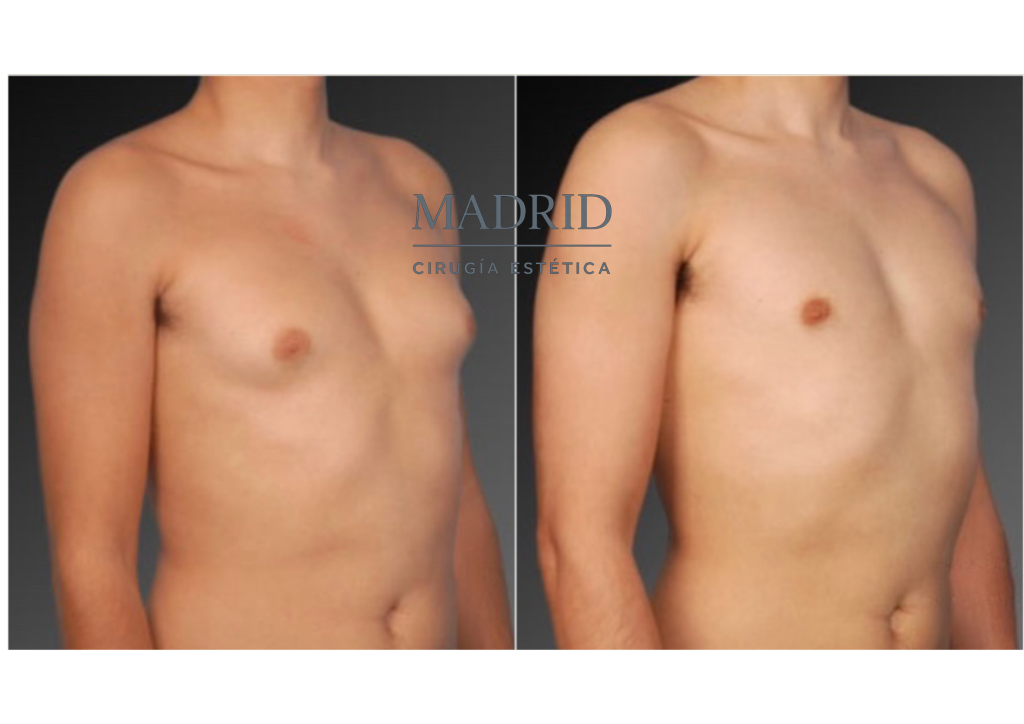 Ginecomastia antes y después