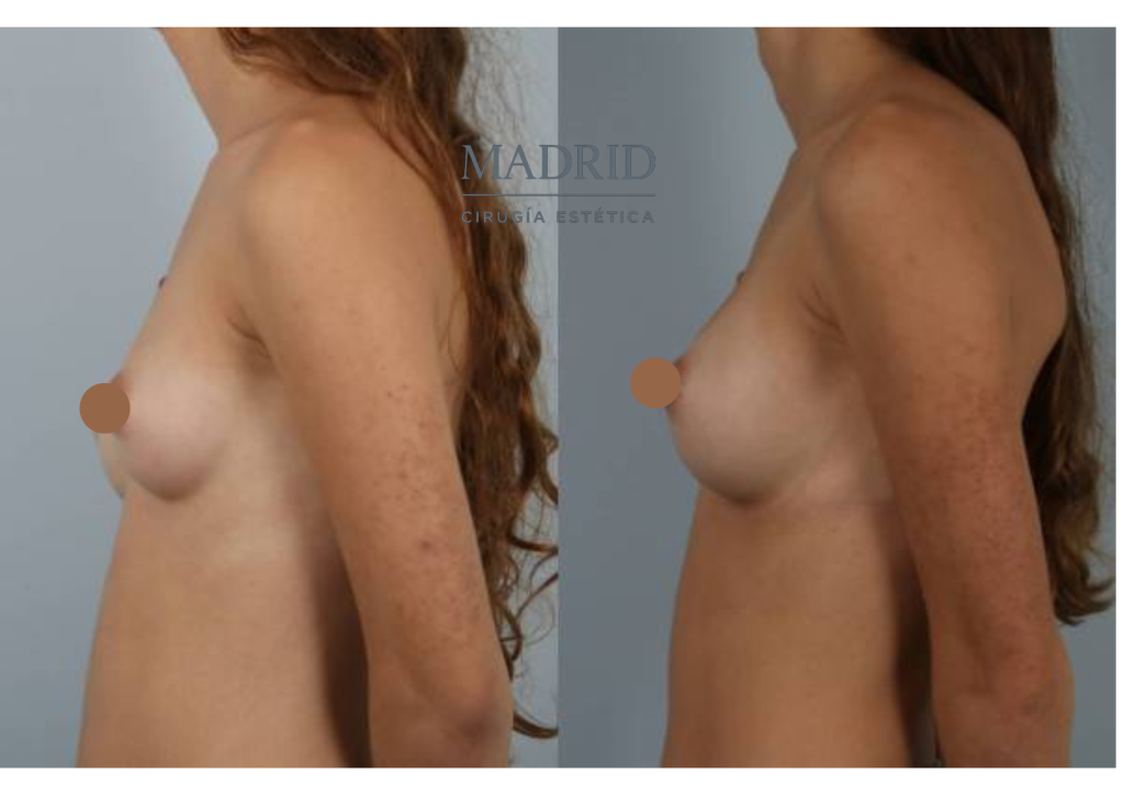 Aumento pecho madrid