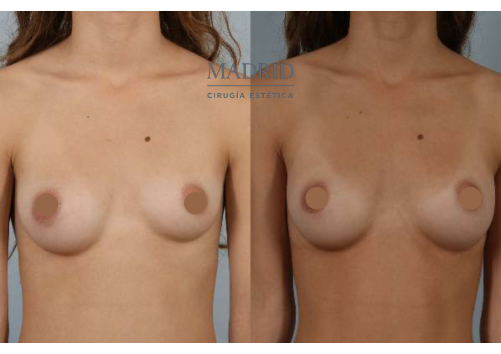Aumento pecho madrid