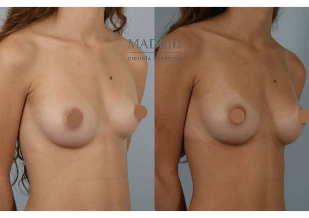 Aumento pecho madrid